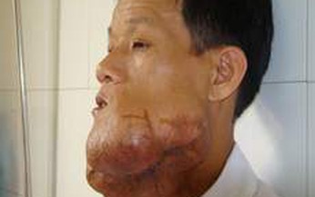 U m&#225;u v&#224; những kh&#243; khăn trong điều trị